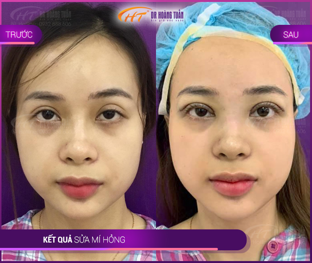 Kết quả sửa mí hỏng tại Thẩm mỹ Hoàng Tuấn